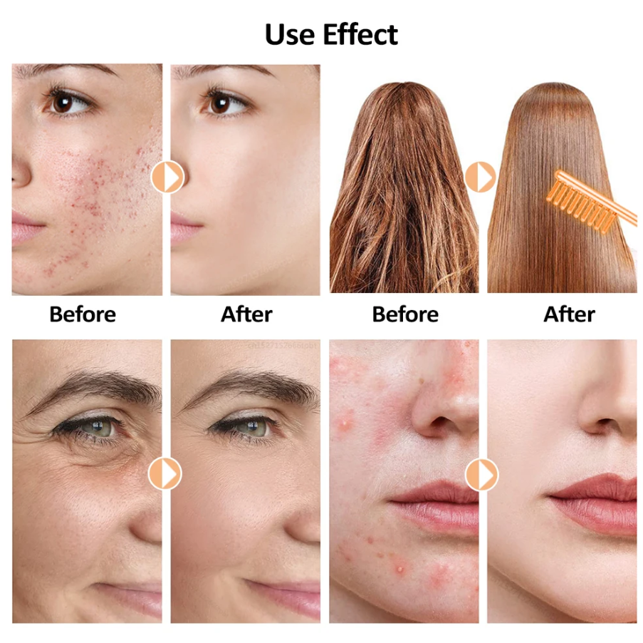Ulmars™ High Frequency Wand - Skin Hair Therapy Machine